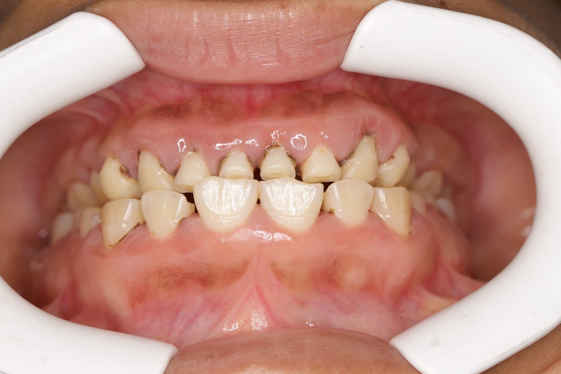 Desgaste dental — 1/3