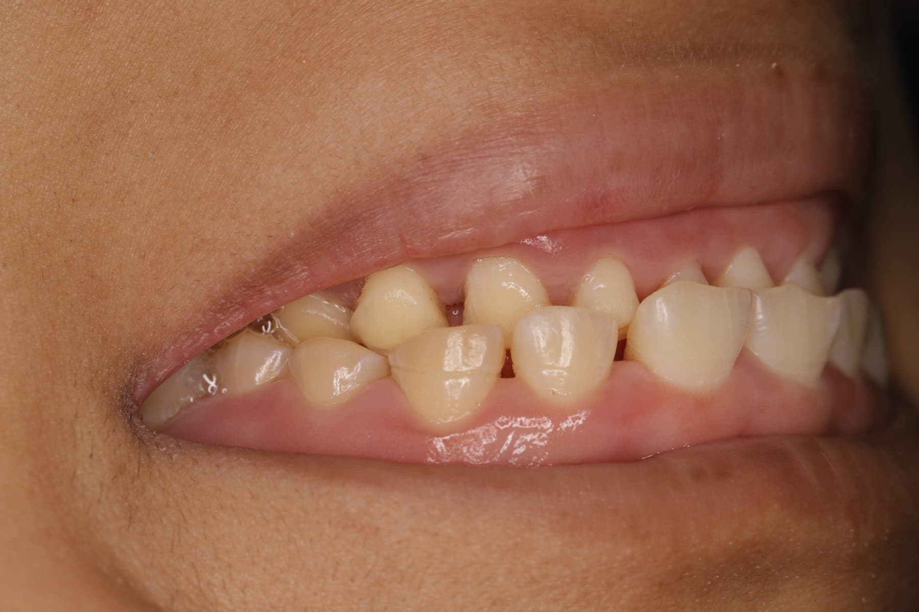 Desgaste dental — 2/3