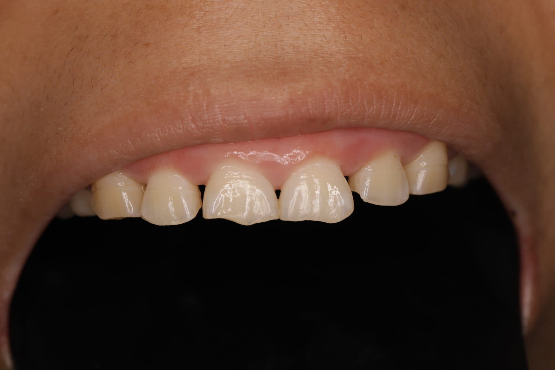Desgaste dental — 3/3