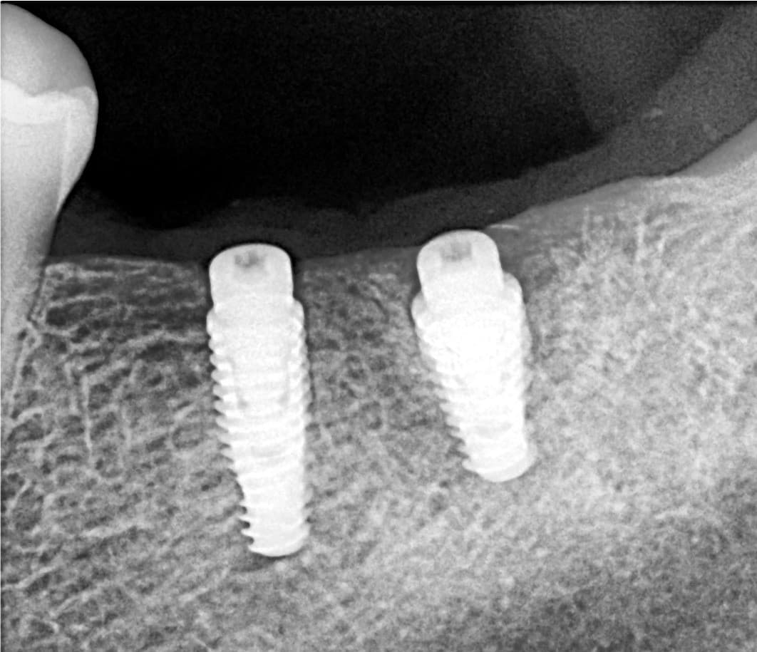 Implantes en molares posteriores — 1/4