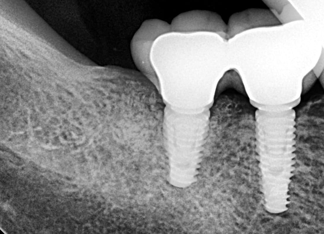 Implantes en molares posteriores — 2/4