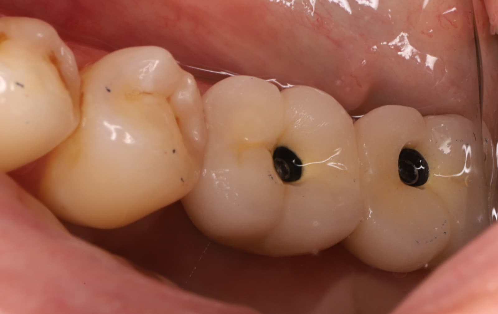 Implantes en molares posteriores — 3/4