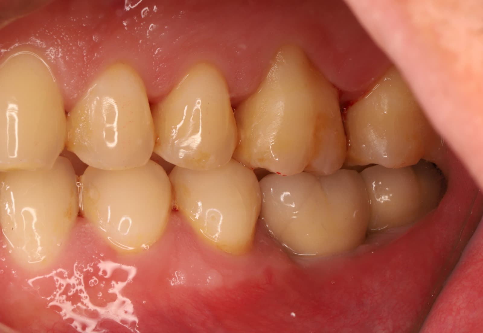 Implantes en molares posteriores — 4/4