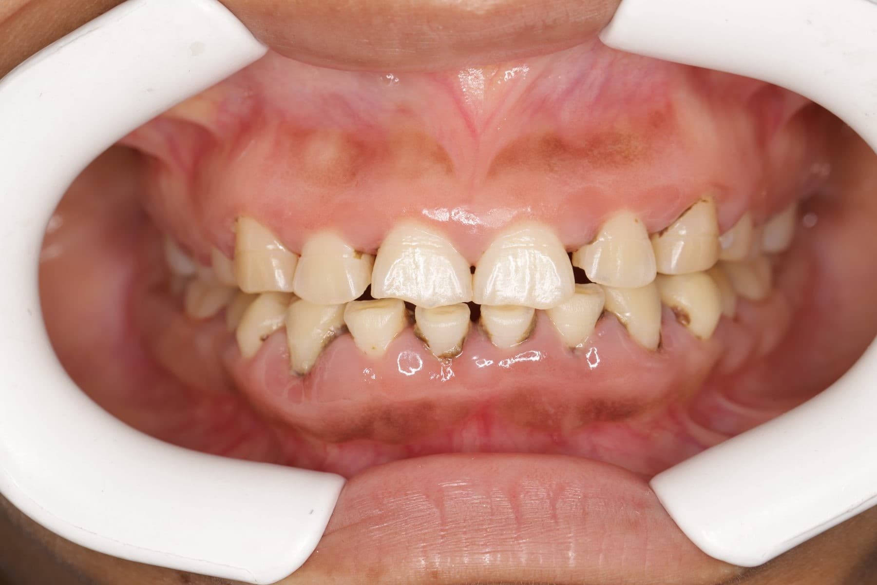 Limpieza dental — 1/3