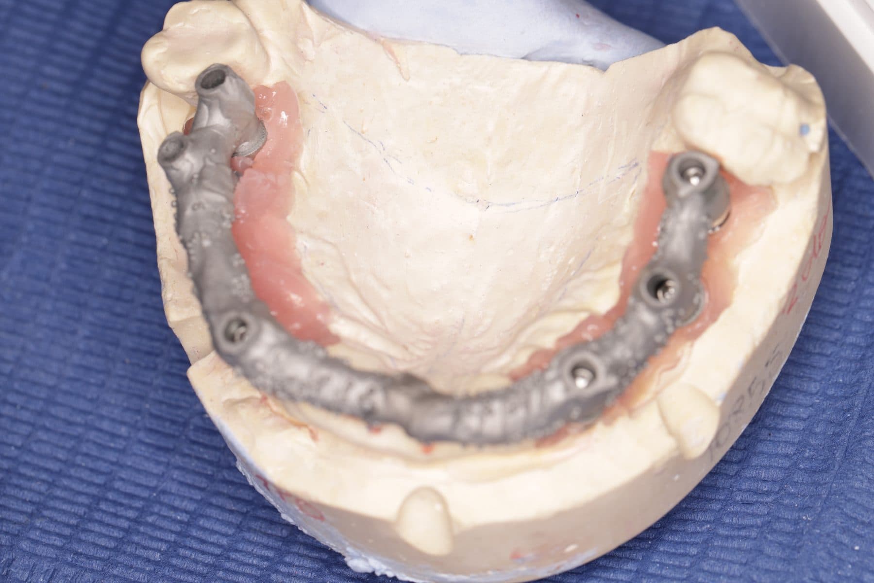 Rehabilitación sobre implantes — 1/4