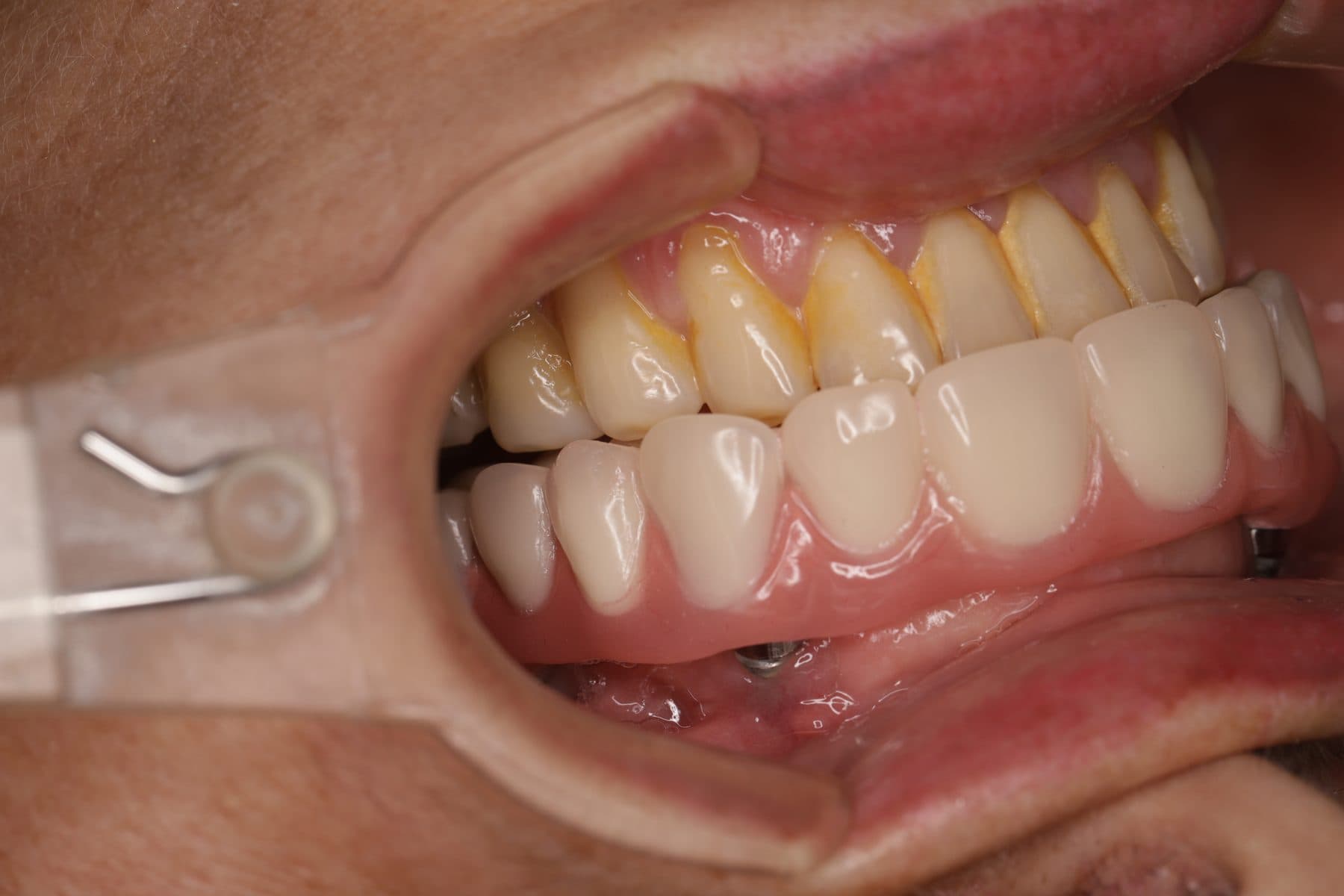 Rehabilitación sobre implantes — 3/4