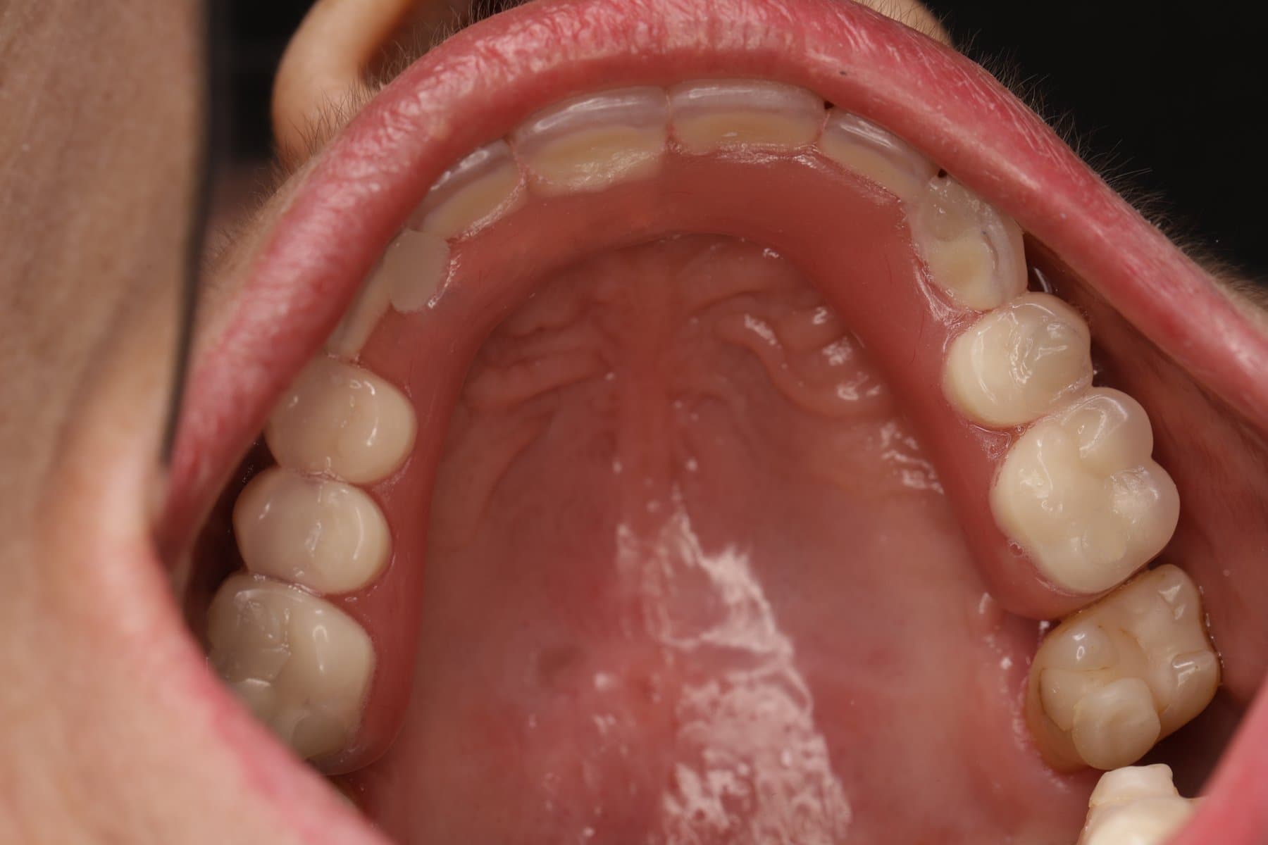 Rehabilitación sobre implantes — 5/5