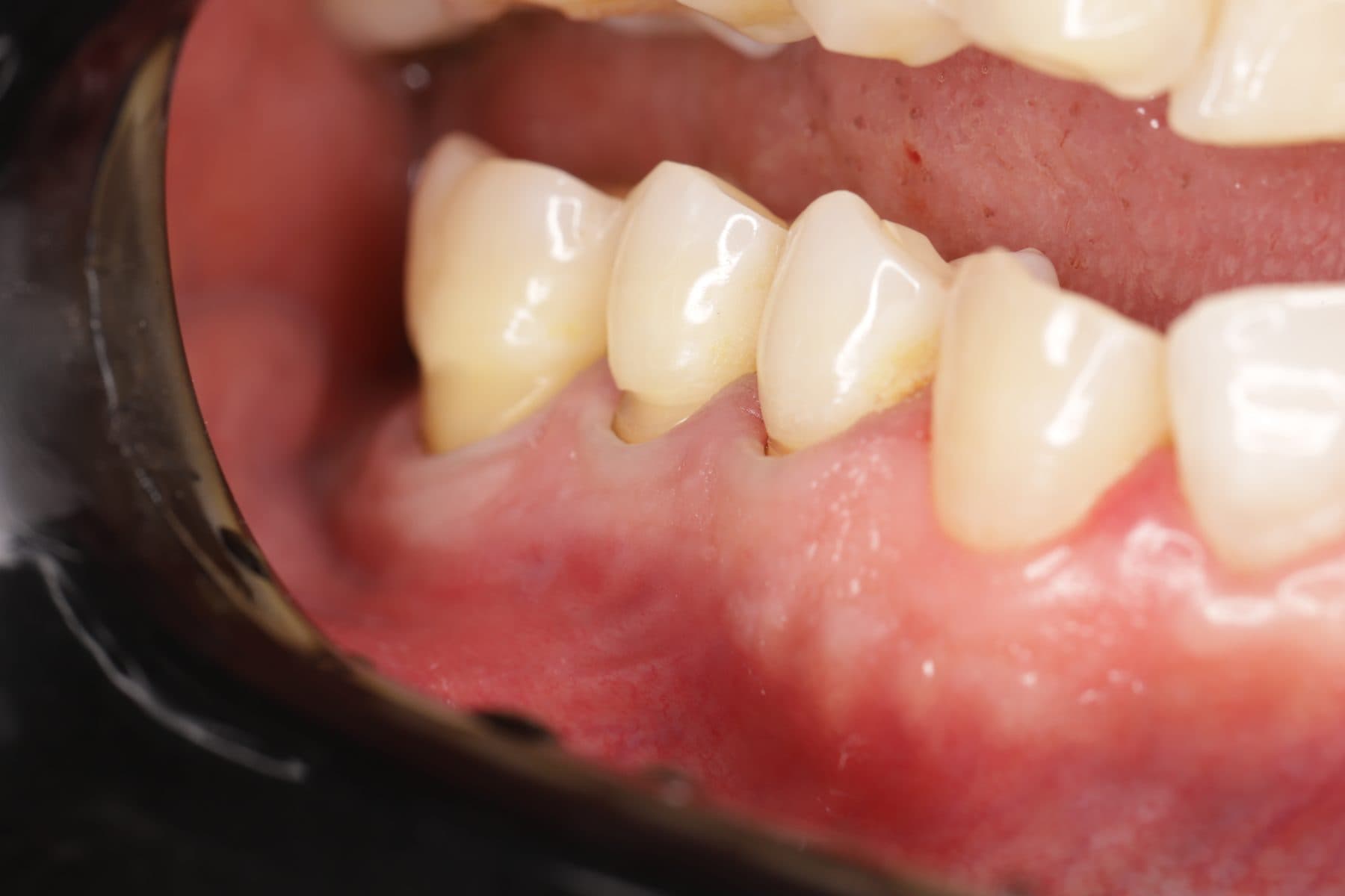 Reparación de cuellos dentales — 1/2