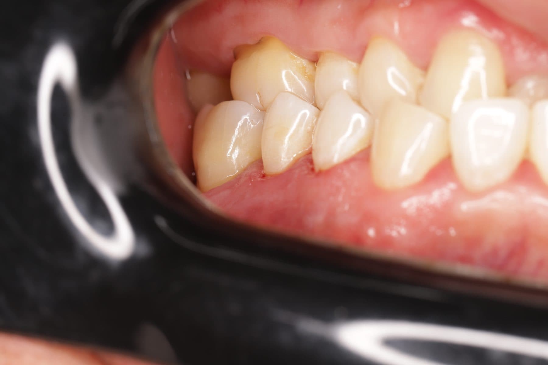 Reparación de cuellos dentales — 2/2