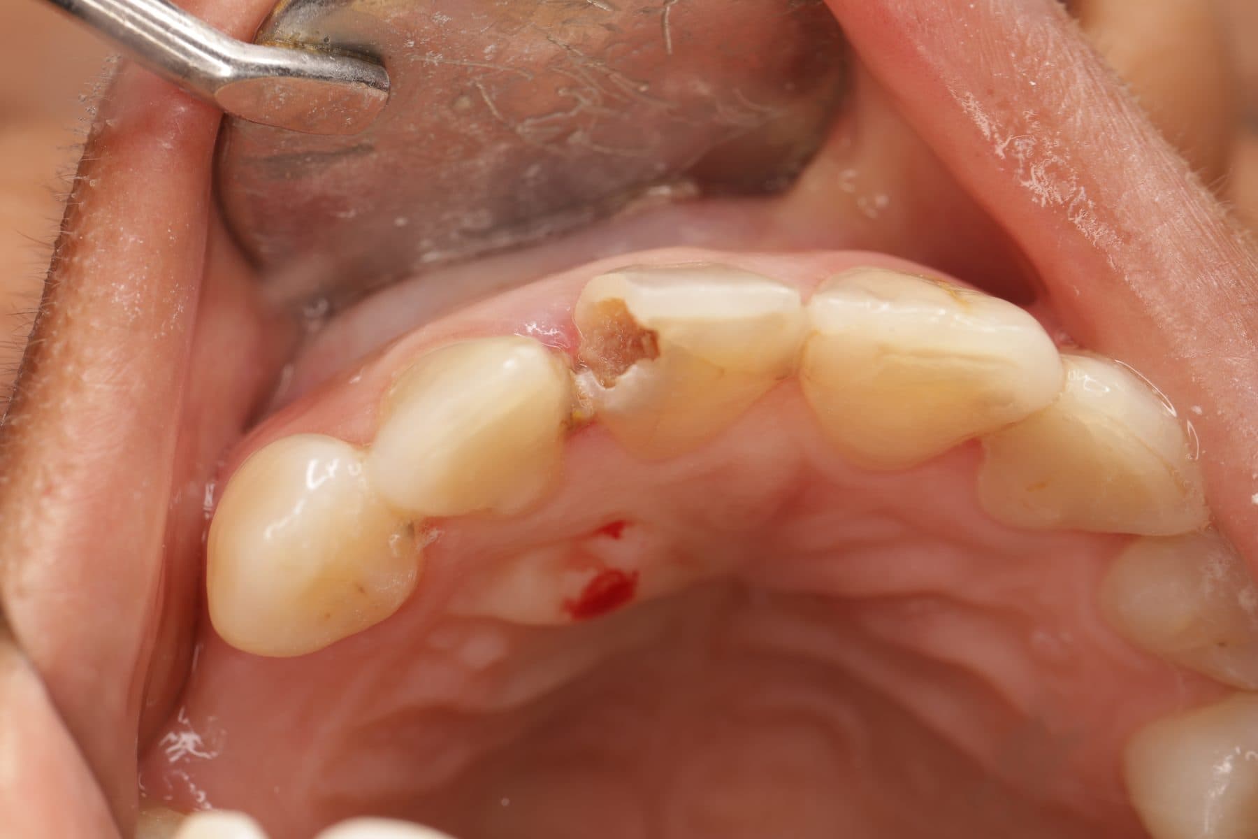 Resina estética anterior — 1/2