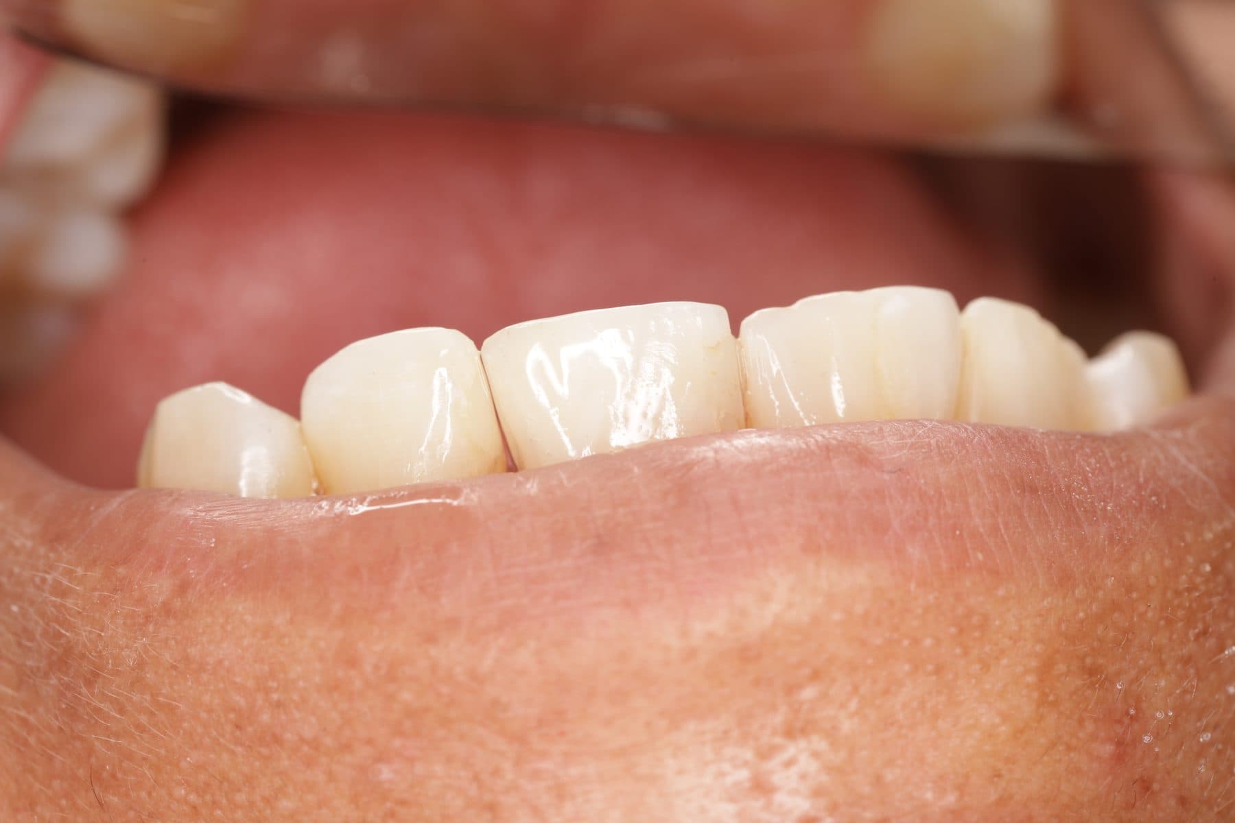 Resina estética anterior — 2/2