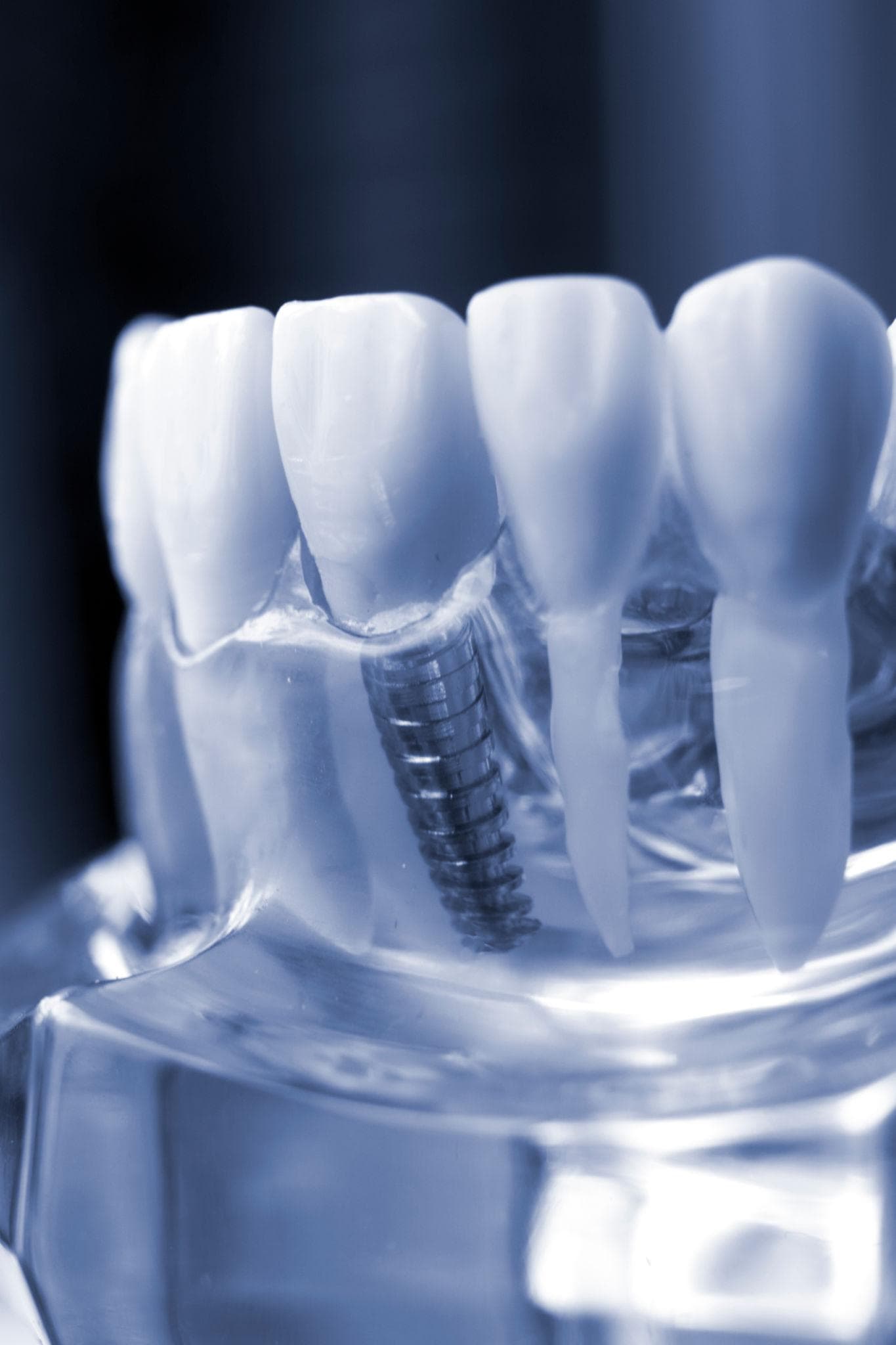 Implantes Dentales